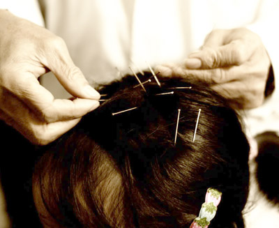Chinese Scalp Acupuncture Chinese Scalp Acupuncture